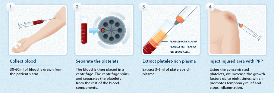 platelet rich plasma