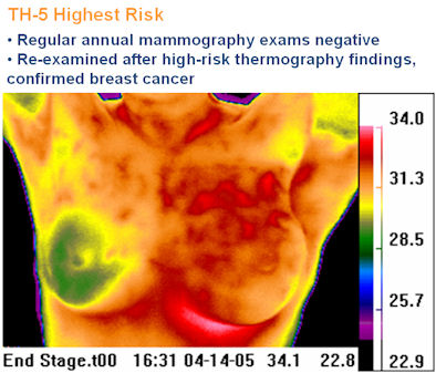 Breast Thermography and Cancer Risk