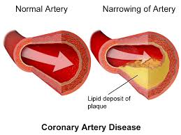 Effects of High blood pressure and cholesterol